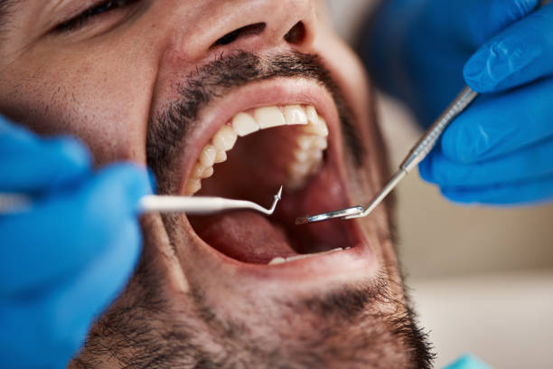 Best Emergency Treatment for Dental Infections or Abscesses in Fort Montgomery, NY